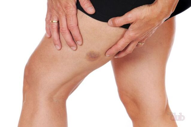 ако се спука вена