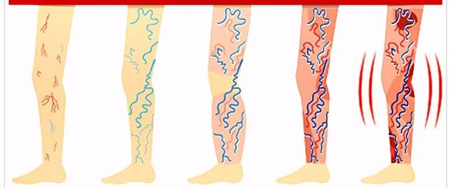 какво да не правим с разширени вени