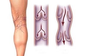 изтичане на кръв при разширени вени на различни етапи от развитие на заболяването